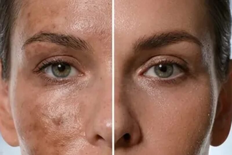 Triple Combination Cream for Melasma: How Short-Term Therapy Delivers Faster Results